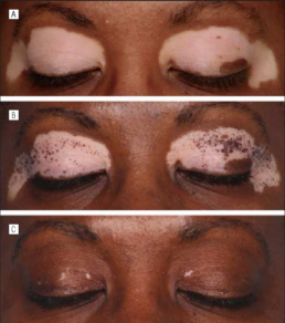 Progressiva scomparsa della Vitiligine dal viso dopo il trattamento con fototerapia UVB